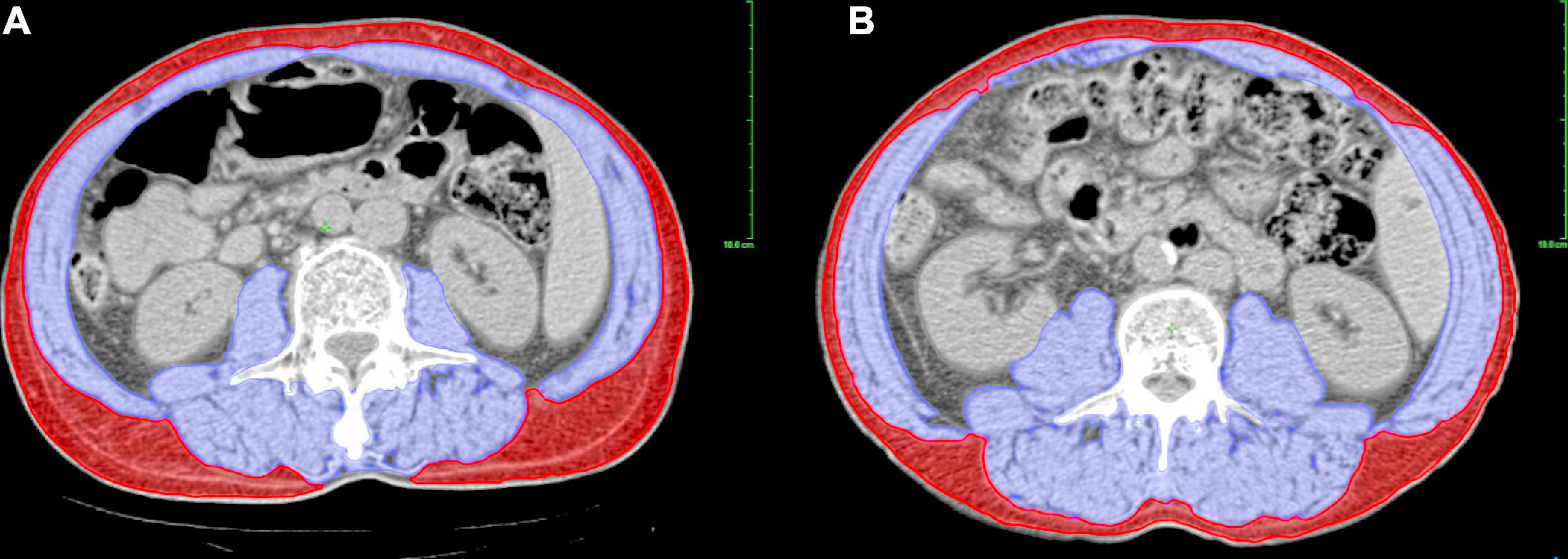 Prognostic impact of sarcopenia in patients with locally advanced adenocarcinoma of the esophagogastric junction treated with neoadjuvant chemoradiotherapy